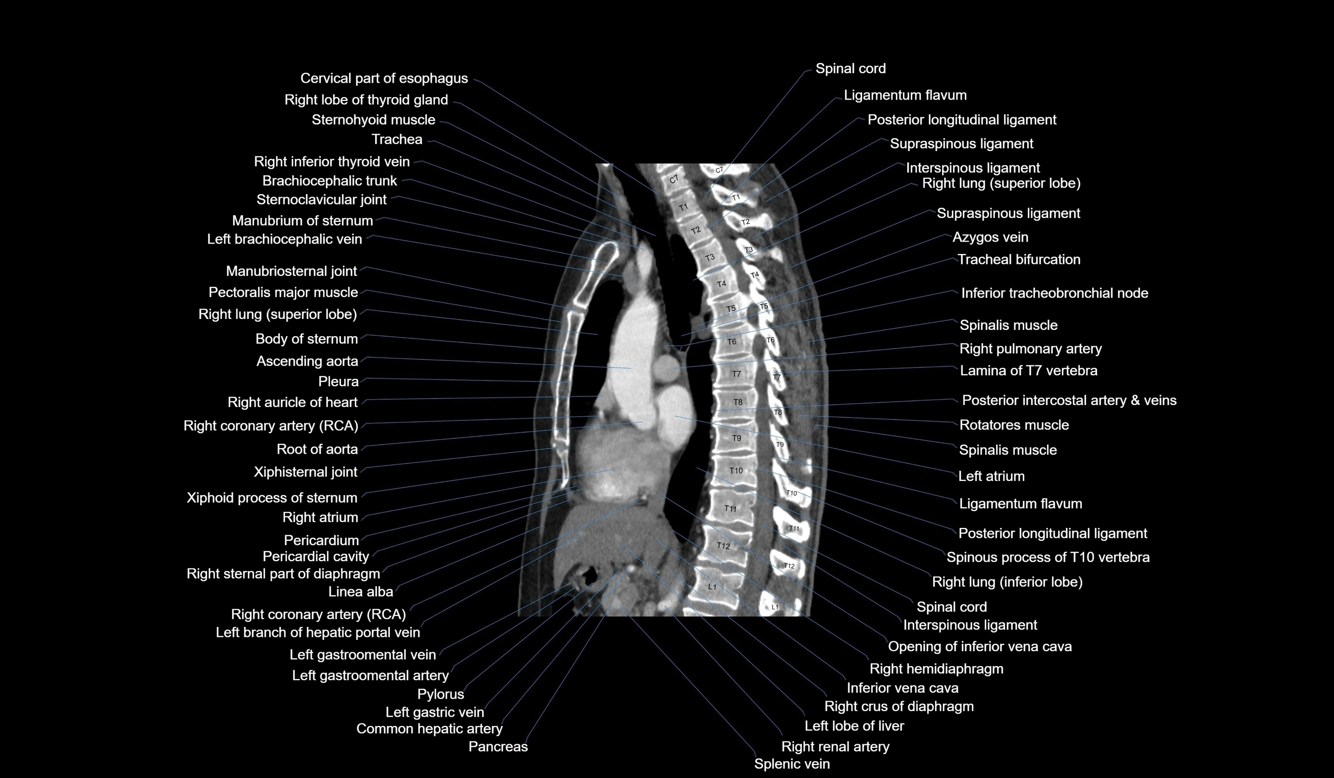 CT chest (thorax) labelled sagittal cross sectional anatomy radiology image-00071.webp